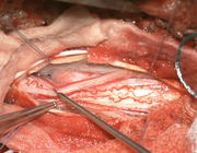 Ventrale transdurale thoracale myelumherniatie
