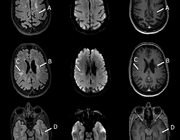 Cerebrale hereditaire angiopathieën (CHA)