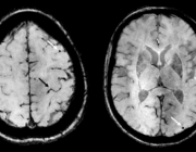 Cerebrale amyloïdangiopathie