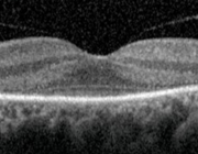 Bilateraal visusverlies door carcinoom-geassocieerde retinopathie bij een cervixcarcinoom